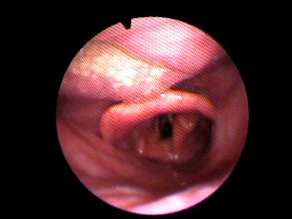 6. throat - flat with jaw thrust