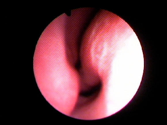 2. left nose